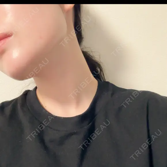 RF（高周波）たるみ治療 ルラ美容クリニック 渋谷本院 DAY 13 メイン用