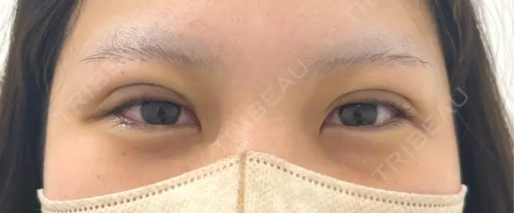 二重埋没 / ヒアルロン酸注入（涙袋） BELINDA CLINIC（ベリンダクリニック）新宿院 DAY 0 メイン用