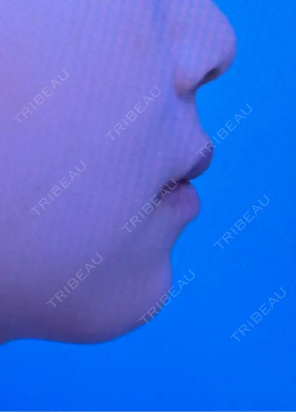 ヒアルロン酸注入（あご） ヴェリテクリニック 大阪院 AFTER メイン用