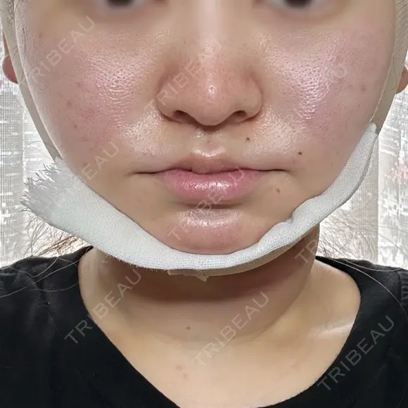 糸リフト / 脂肪吸引（顔） / ボトックス（エラ・小顔） HAAB×DREAM BEAUTY CLINIC 東京本院 DAY 1 メイン用