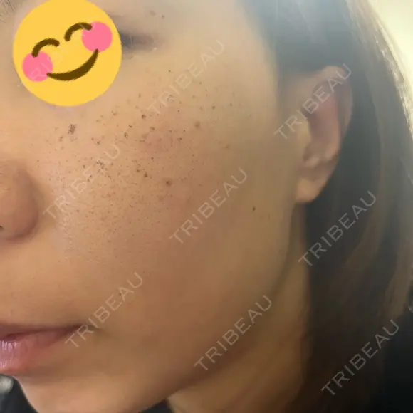 ルメッカ Belle Via Skin Clinic DAY 2 メイン用