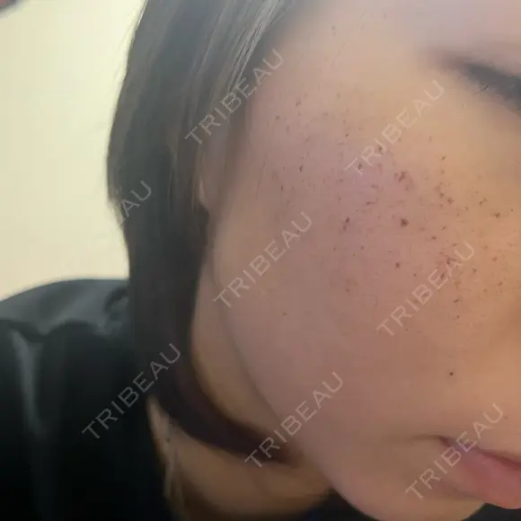 ルメッカ Belle Via Skin Clinic DAY 2 メイン用