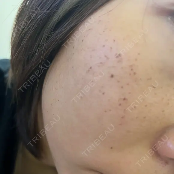 ルメッカ Belle Via Skin Clinic DAY 3 メイン用