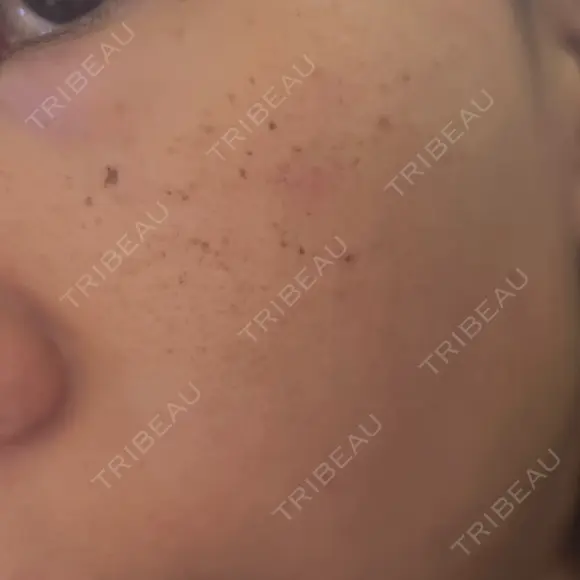 ルメッカ Belle Via Skin Clinic DAY 4 メイン用