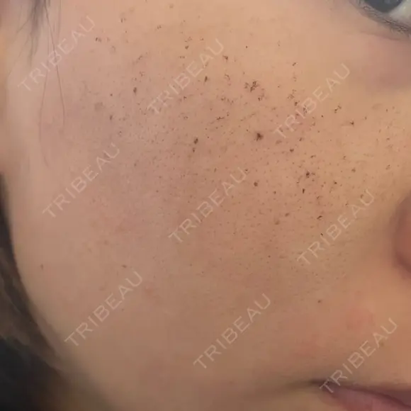 ルメッカ Belle Via Skin Clinic DAY 4 メイン用