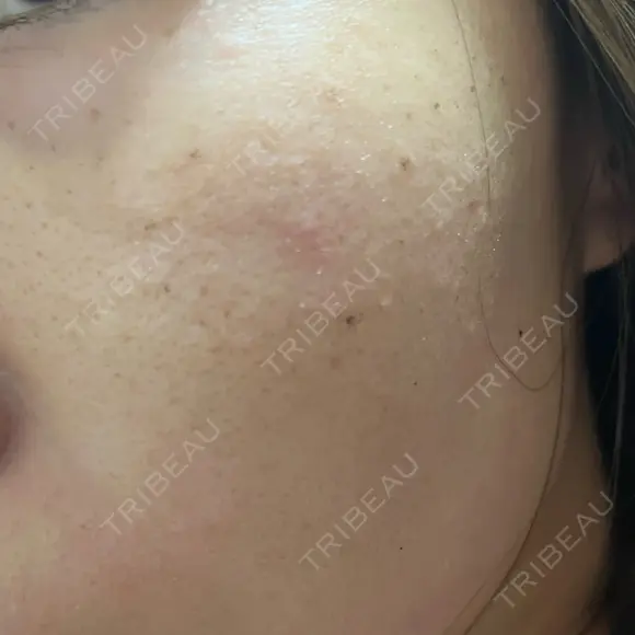 ルメッカ Belle Via Skin Clinic AFTER メイン用