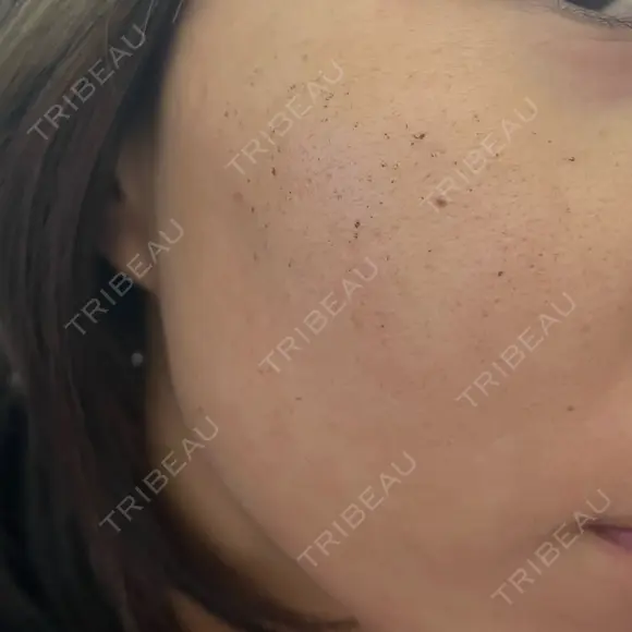 ルメッカ Belle Via Skin Clinic DAY 5 メイン用