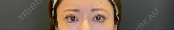 二重埋没 / タレ目形成・グラマラスライン（埋没） LOUIS CLINIC 二子玉川院【ルイクリニック】 DAY 0 メイン用
