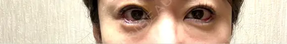 二重埋没 / タレ目形成・グラマラスライン（埋没） LOUIS CLINIC 二子玉川院【ルイクリニック】 DAY 3 メイン用
