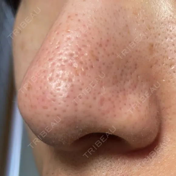 アグネス / その他（鼻） フェアクリニック川口 DAY 8 メイン用