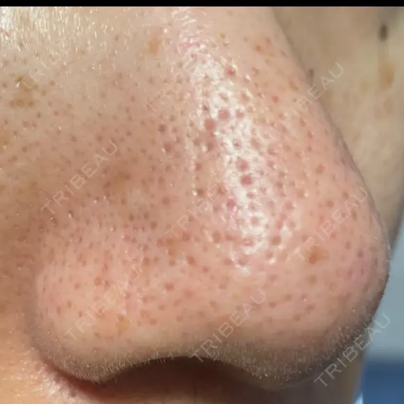 アグネス / その他（鼻） フェアクリニック川口 DAY 8 メイン用