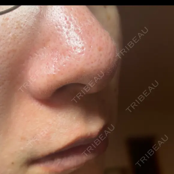 アグネス / その他（鼻） フェアクリニック川口 DAY 9 メイン用