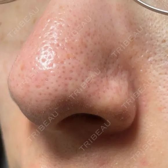 アグネス / その他（鼻） フェアクリニック川口 DAY 9 メイン用