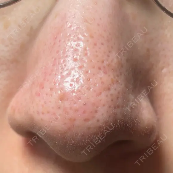 アグネス / その他（鼻） フェアクリニック川口 DAY 9 メイン用