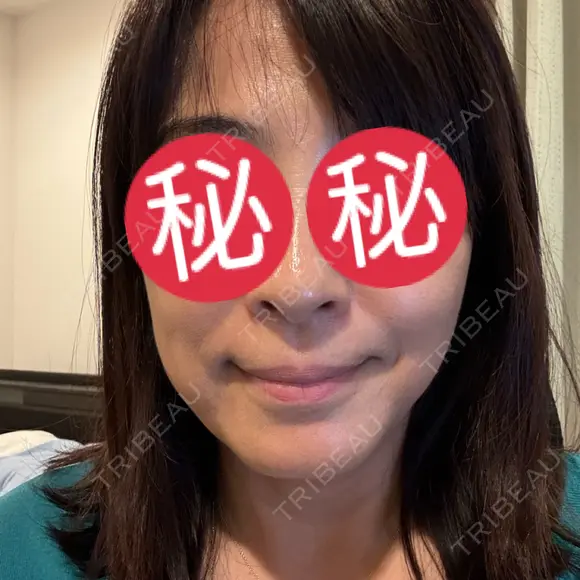 ハイフ（顔） ASTRA BEAUTY CLINIC AFTER メイン用