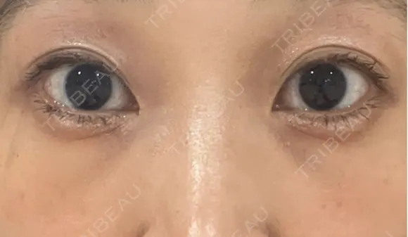 その他（目元） / クマ治療 / 下まぶたたるみ取り / 下まぶたの脂肪取り お茶の水美容形成クリニック DAY 26 メイン用