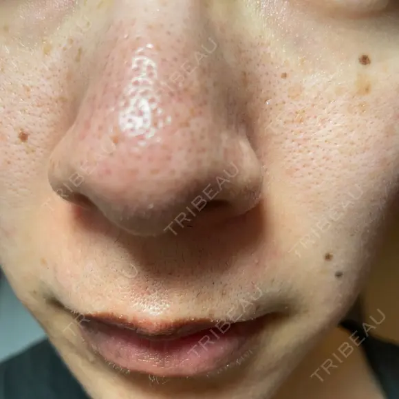 アグネス / その他（鼻） フェアクリニック川口 AFTER メイン用