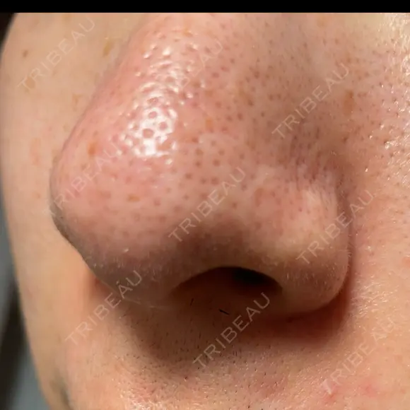 アグネス / その他（鼻） フェアクリニック川口 DAY 10 メイン用