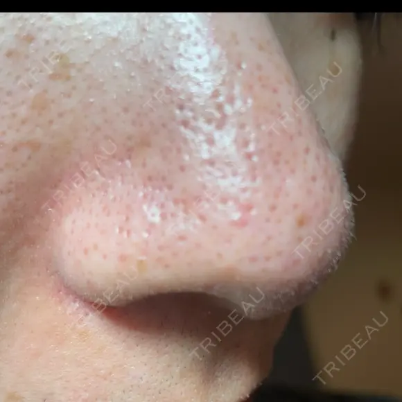 アグネス / その他（鼻） フェアクリニック川口 DAY 10 メイン用