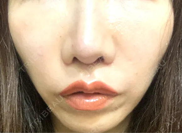 ヒアルロン酸注入（唇） / ボトックス（口角） おおたかの森ビューティークリニック DAY 0 メイン用