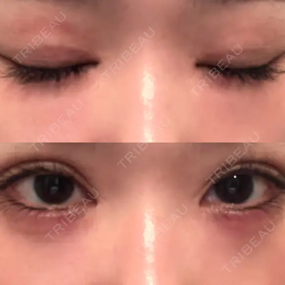 自然癒着法 シンデレラ＆ダヴィンチクリニック AFTER メイン用