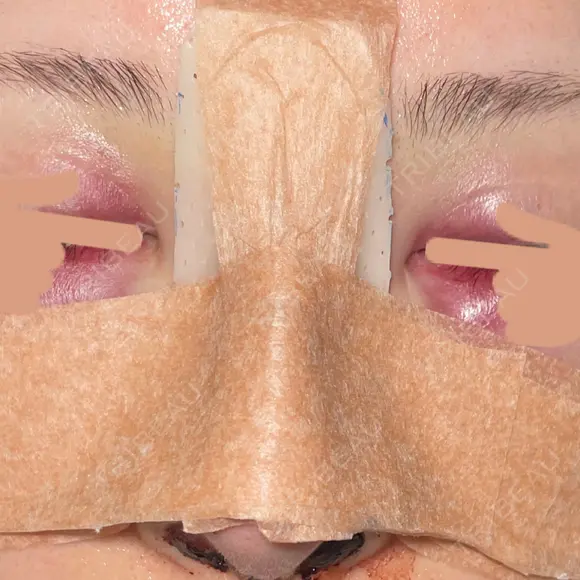 鼻尖形成（切開） / 軟骨移植 / 骨切幅寄せ / プロテーゼ除去 9BeautyClinic DAY 1 メイン用