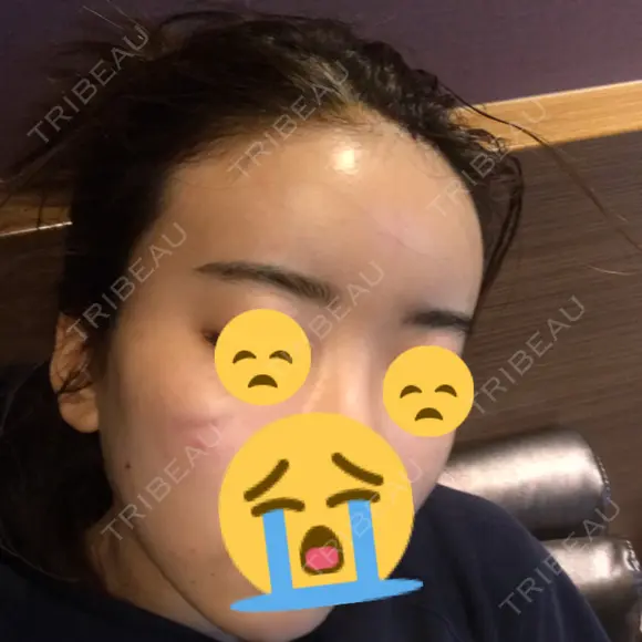 脂肪吸引（顔） / 額を丸く / 脂肪吸引（脚） / こめかみ形成 / 輪郭修正 / 脂肪注入（額） / 脂肪注入（輪郭） フレッシュ整形外科 DAY 63 メイン用