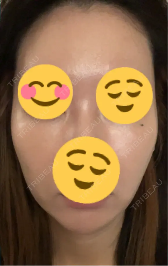 その他（輪郭） ARTE BEAUTY CLINIC DAY 2 メイン用