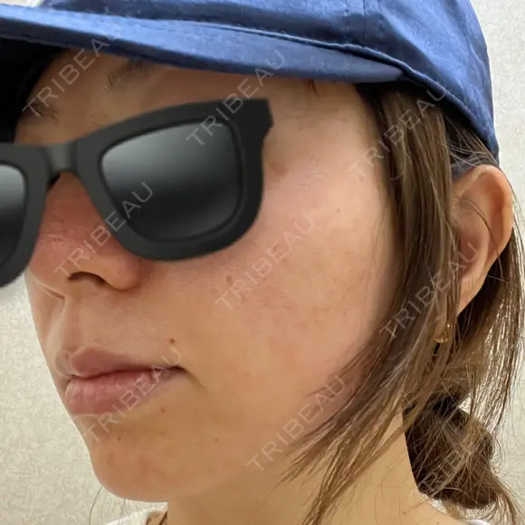 ピコレーザートーニング（美白・肝斑） / フラクショナルレーザー（毛穴・ニキビ跡） G MEDICAL ART クリニック 新宿院 DAY 0 メイン用