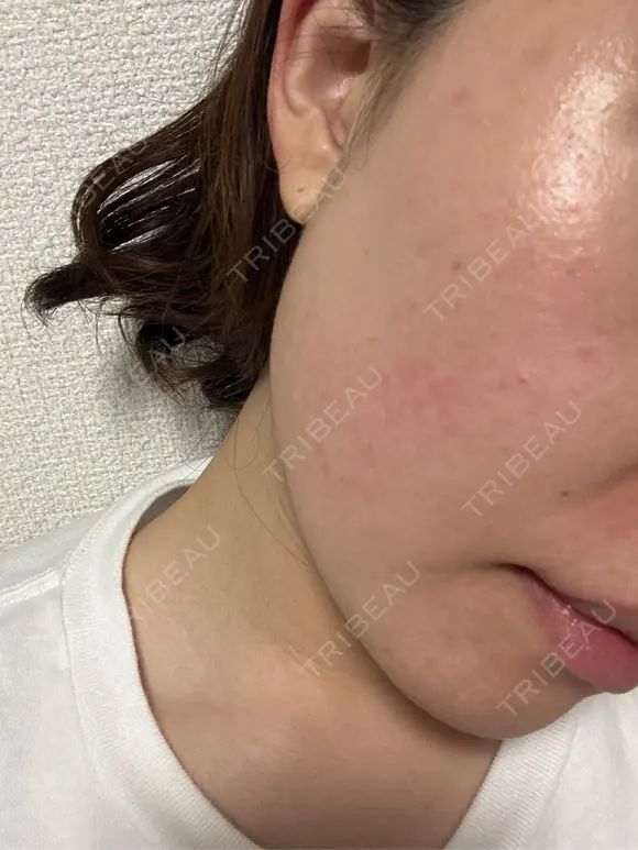 イオン導入 / エレクトロポレーション / 毛穴洗浄（ハイドラフェイシャルなど） oneUPclinic AFTER メイン用