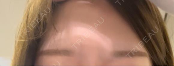 ボトックス（あご） / ボトックス（眉間） / ボトックス（額） ルラ美容クリニック銀座院 AFTER メイン用