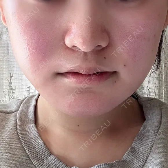 糸リフト / 脂肪吸引（顔） / ボトックス（エラ・小顔） HAAB×DREAM BEAUTY CLINIC 東京本院 DAY 14 メイン用