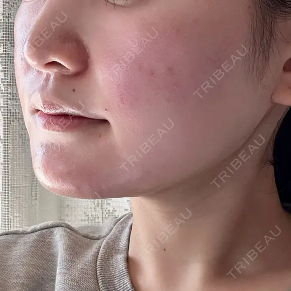 糸リフト / 脂肪吸引（顔） / ボトックス（エラ・小顔） HAAB×DREAM BEAUTY CLINIC 東京本院 DAY 14 メイン用