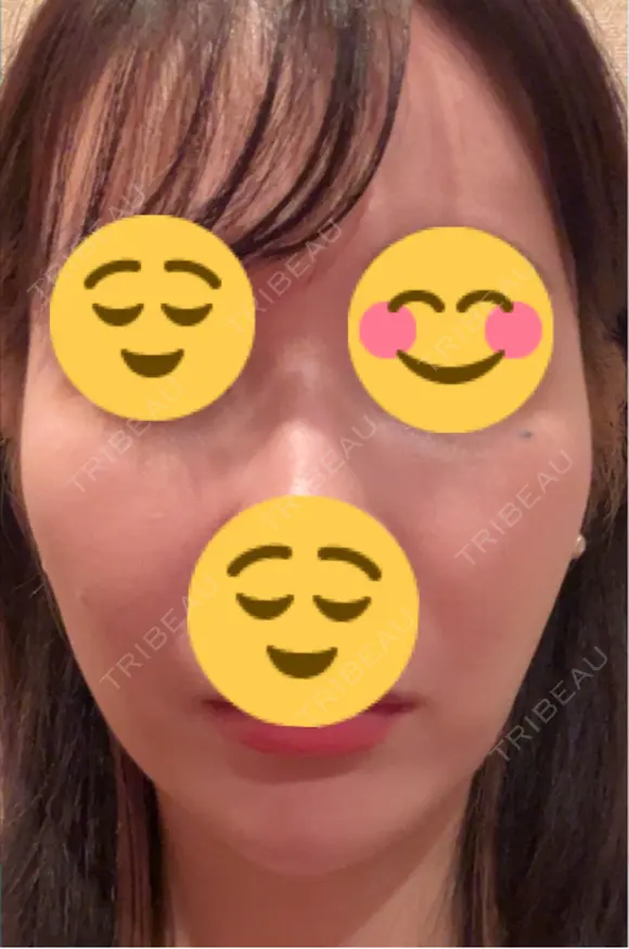 その他（輪郭） ARTE BEAUTY CLINIC DAY 3 メイン用