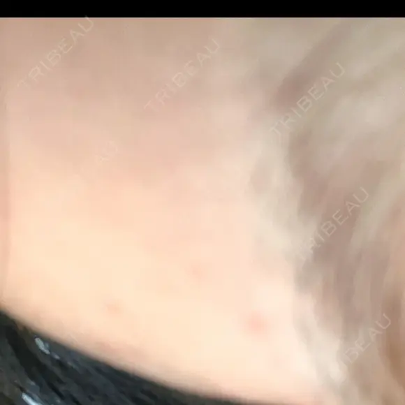 医療脱毛（顔） 共立美容外科 福岡院 AFTER メイン用