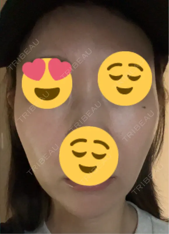 その他（輪郭） ARTE BEAUTY CLINIC DAY 4 メイン用