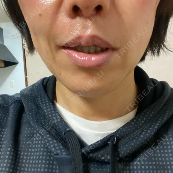 人中短縮 / 口角挙上 / その他（口元） ルラ美容クリニック 神戸院 DAY 46 メイン用
