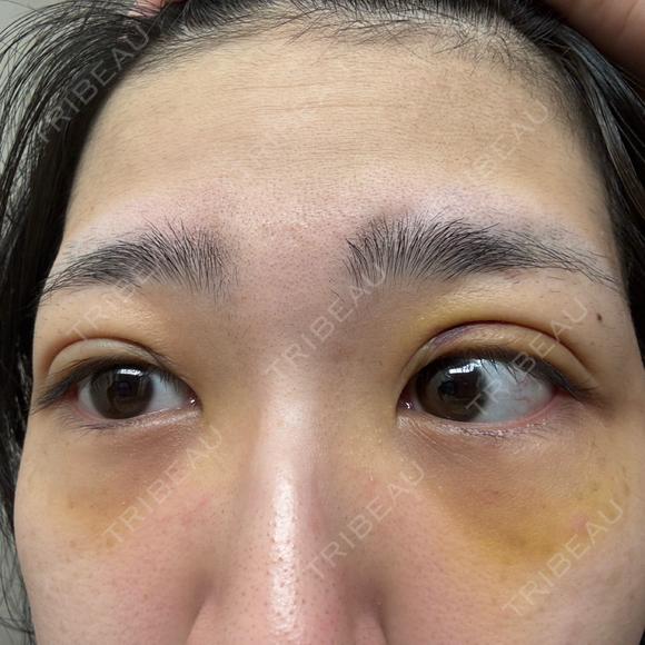 二重埋没 / クマ治療 湘南美容クリニック 西葛西院 AFTER メイン用