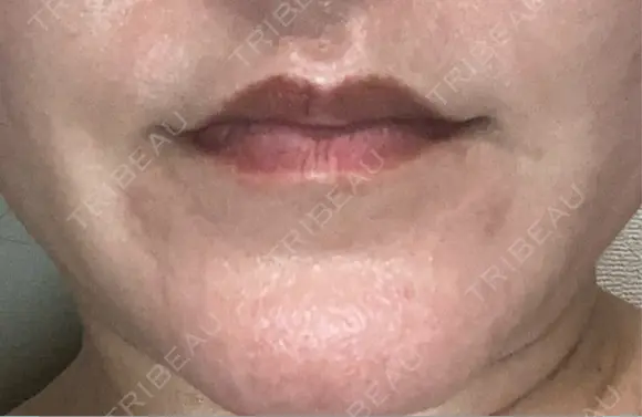 ボトックス（人中） BON BON CLINIC 銀座駅前本院 AFTER メイン用