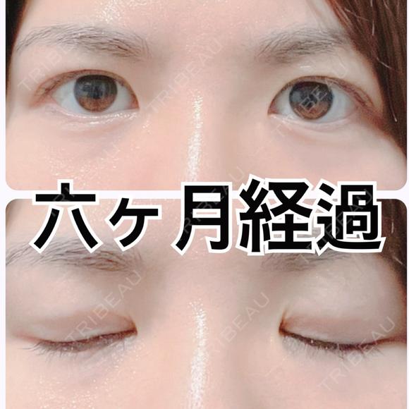 その他（目元） / 自然癒着法 LUHO（ルホ）美容外科 AFTER メイン用