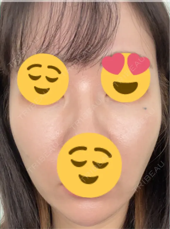 その他（輪郭） ARTE BEAUTY CLINIC DAY 5 メイン用