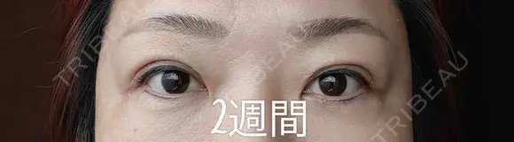 目元修正 / 自然癒着法 LUHO（ルホ）美容外科 DAY 15 メイン用