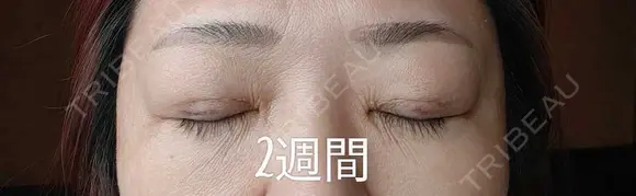 目元修正 / 自然癒着法 LUHO（ルホ）美容外科 DAY 15 メイン用