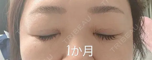 目元修正 / 自然癒着法 LUHO（ルホ）美容外科 DAY 34 メイン用