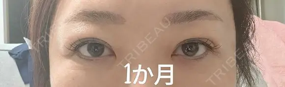目元修正 / 自然癒着法 LUHO（ルホ）美容外科 DAY 34 メイン用