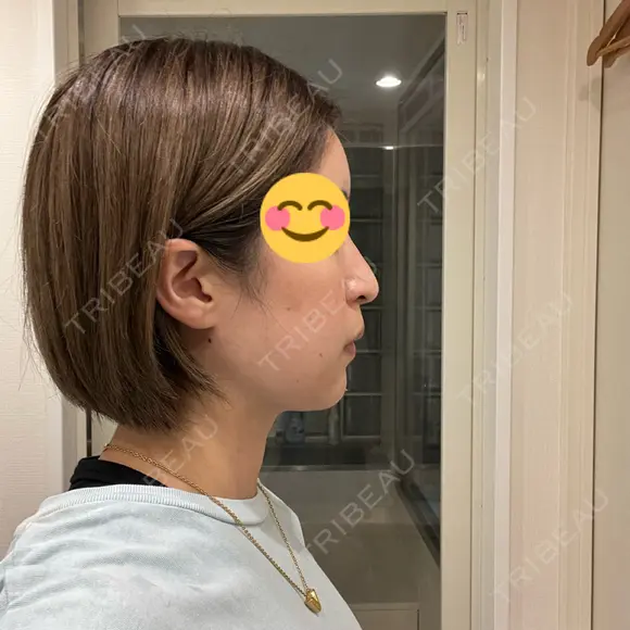 脂肪吸引（顔） お茶の水美容形成クリニック AFTER メイン用