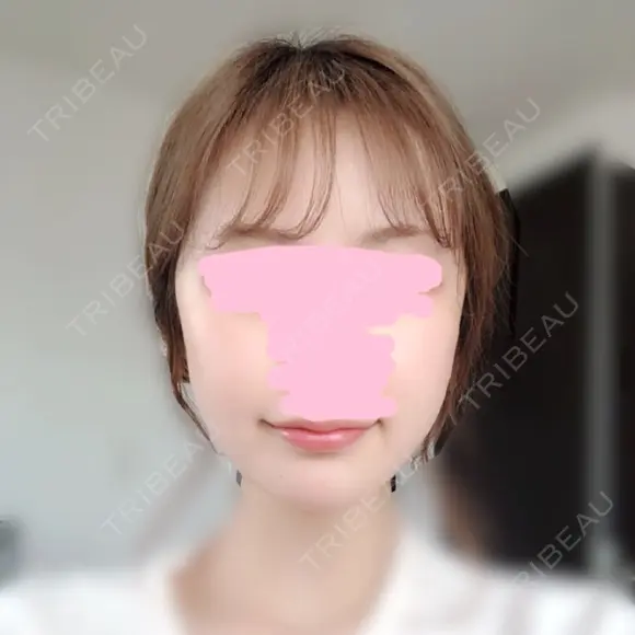 骨削り（頬） FROM B整形外科 (旧バウム整形外科) DAY 16 メイン用