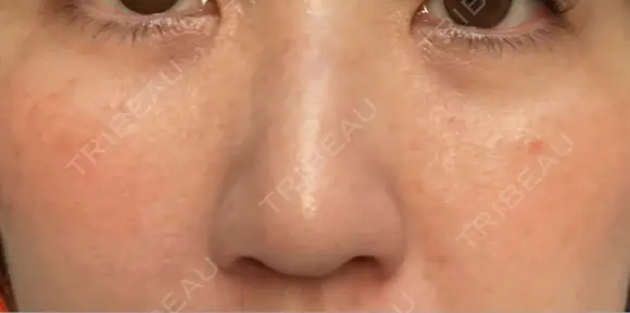 クマ治療 / 下まぶたの脂肪取り ROOTS Clinic DAY 12 メイン用