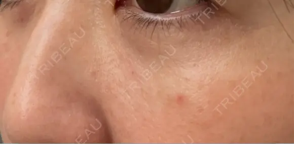 クマ治療 / 下まぶたの脂肪取り ROOTS Clinic DAY 12 メイン用