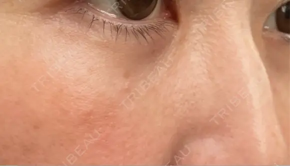 クマ治療 / 下まぶたの脂肪取り ROOTS Clinic DAY 12 メイン用